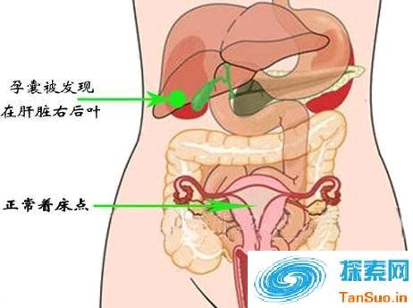 一妇女将宝宝怀在肝脏上 万分之一的概率是如何做到的？